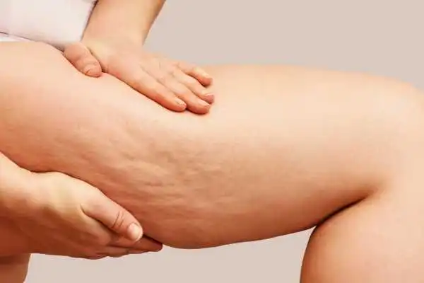 Image of woman showing leg with cellulite Stowmarket