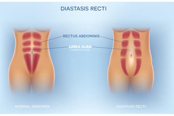 What Non-Surgical Options Are Available for Diastasis Recti Stowmarket?