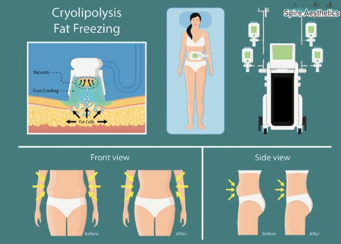 Image of diet and fat freezing combined for best results for Spire Aesthetics Stowmarket