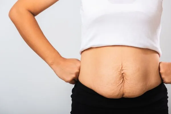Image of a woman's stomach after weight loss with sagging skin following a gastric band Stowmarket