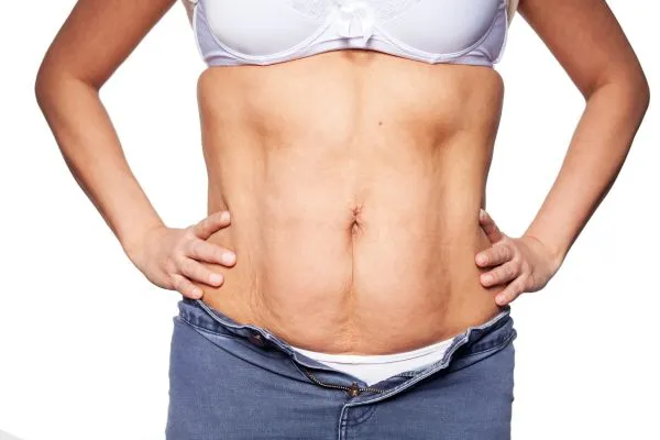 sagging skin on woman's stomach after weight loss injections Stowmarket