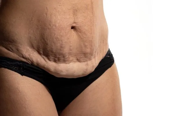 Image of womans stomach after weight loss injections Stowmarket showing saggy skin